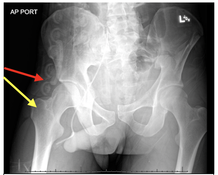 What are open book pelvic fractures?